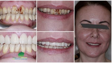 dental implants penge|Dentist in Penge .